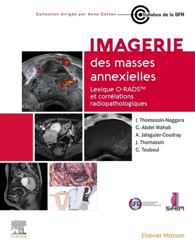 Imagerie des masses annexielles. Lexique O-RADS et corrélations radiopathologiques