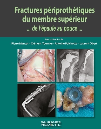 Fractures périprothétiques du membre supérieur... de l'épaule au pouce...